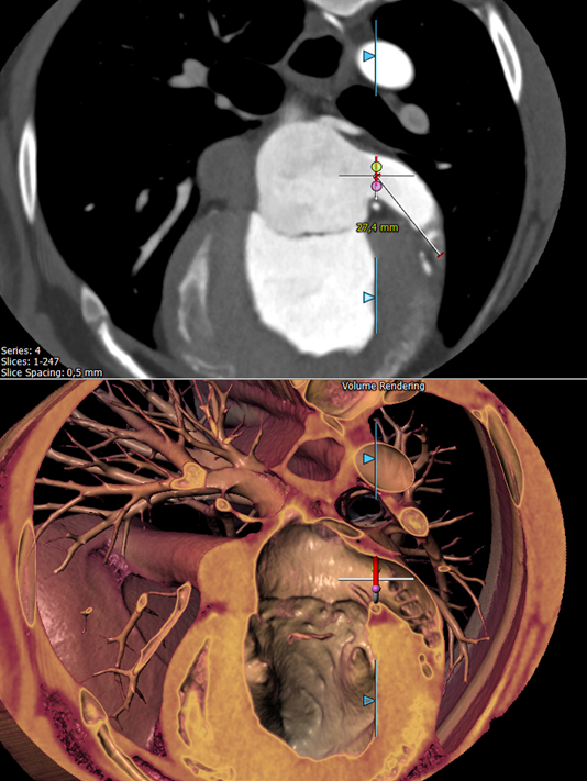immr - CT-scan